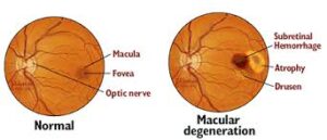 Age Related Macular Degeneration