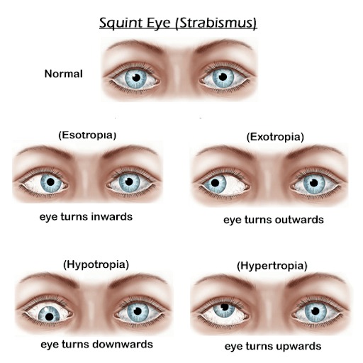 Squint Surgery