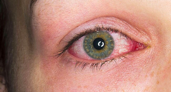 Uveitis