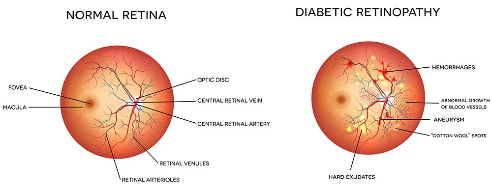 diabetic-retinopathy