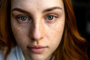 Comprehensive Guide to Understanding and Treating Acne