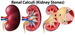 Renal Calculi, or Kidney Stones