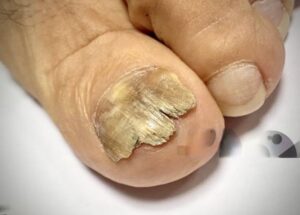 Nail Fungus