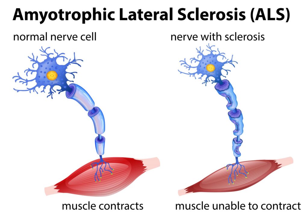 Amyotrophic-Lateral-Sclerosis-ALS