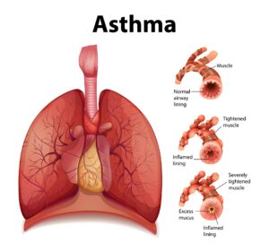 Asthma