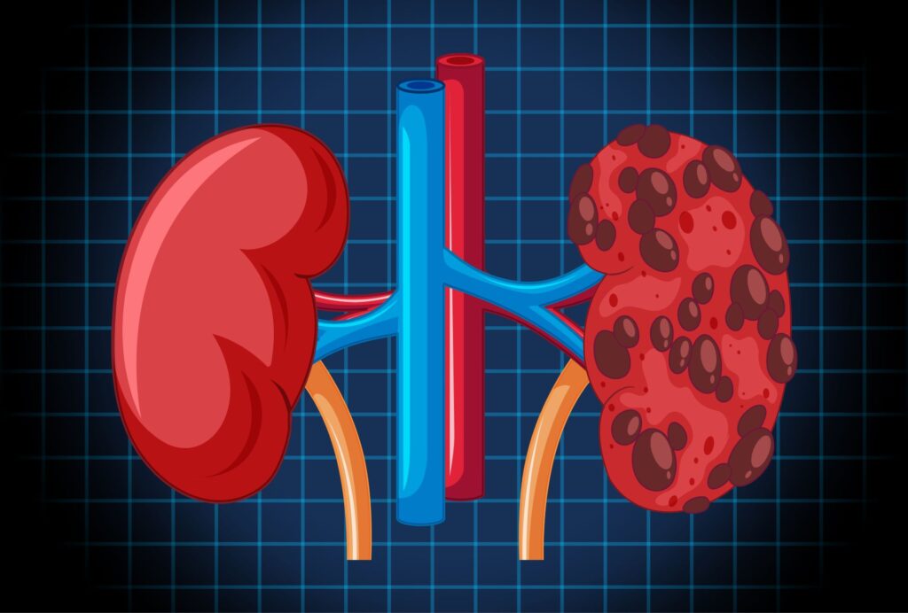 Chronic Kidney Disease (CKD)