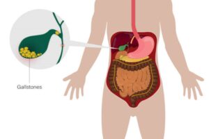 Gallstones