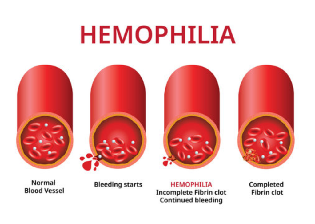 Hemophilia