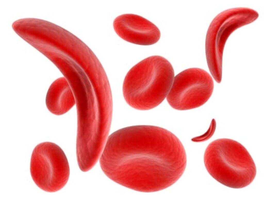 Sickle-Cell