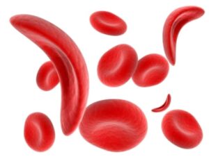 Sickle-Cell