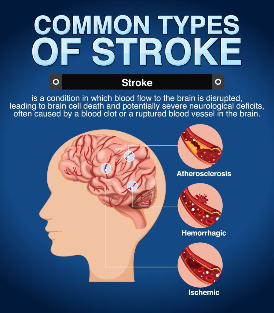 Stroke