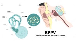 Benign_Paroxysmal_Positional_Vertigo