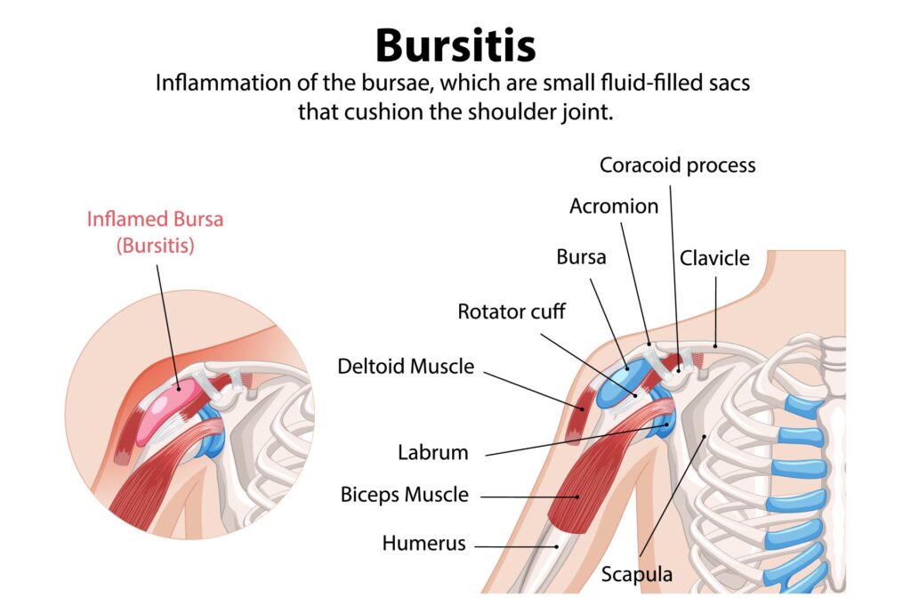 Bursitis