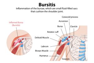 Bursitis