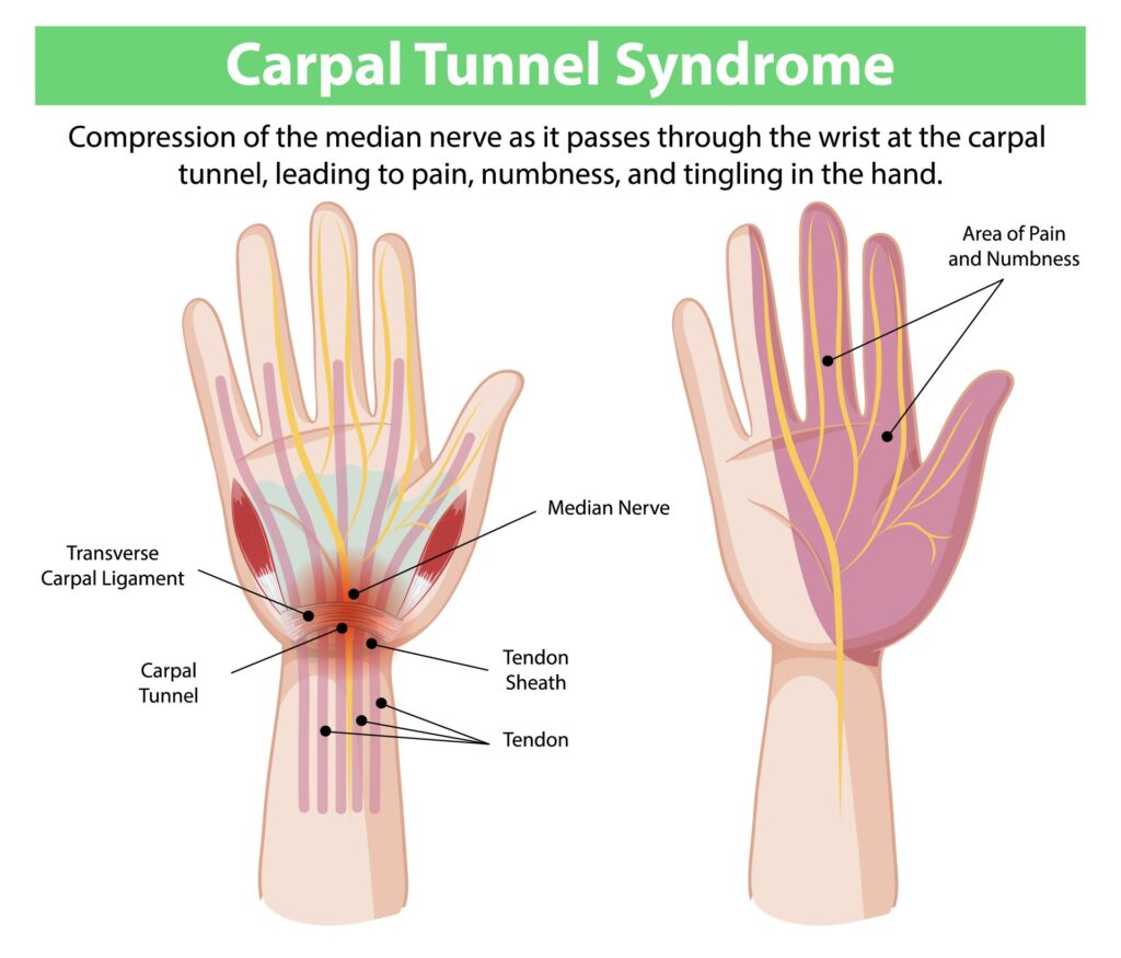 Carpal Tunnel Syndrome (CTS)