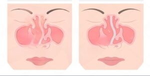 Deviated Nasal Septum