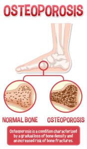 Osteoarthritis