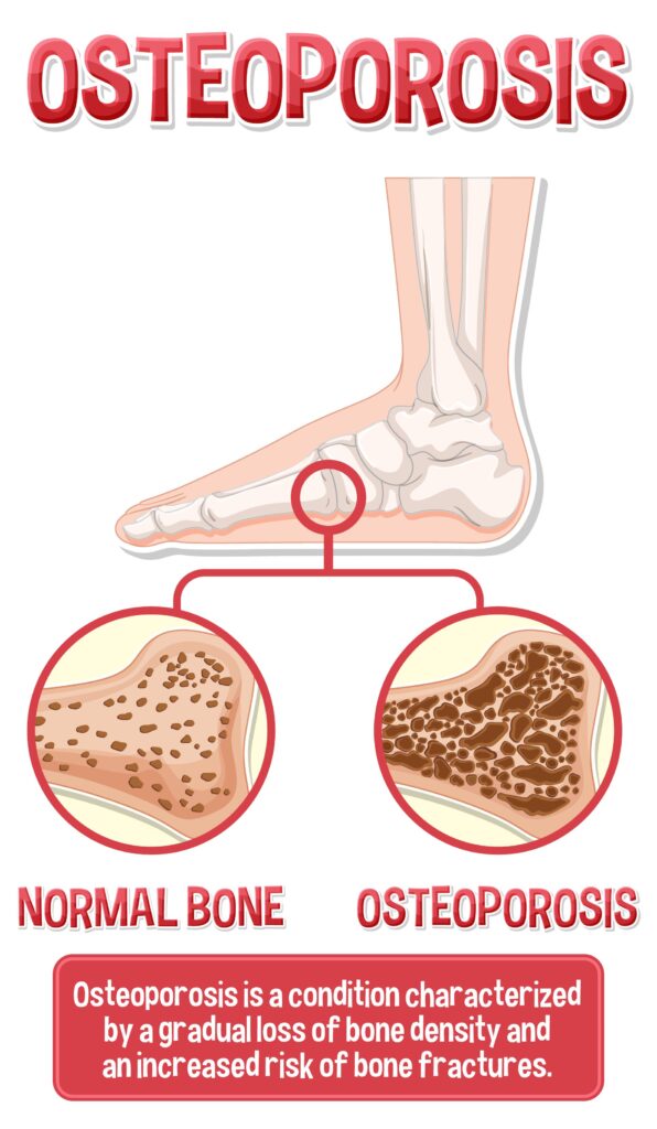 Osteoarthritis