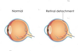 Retinal-Detachment