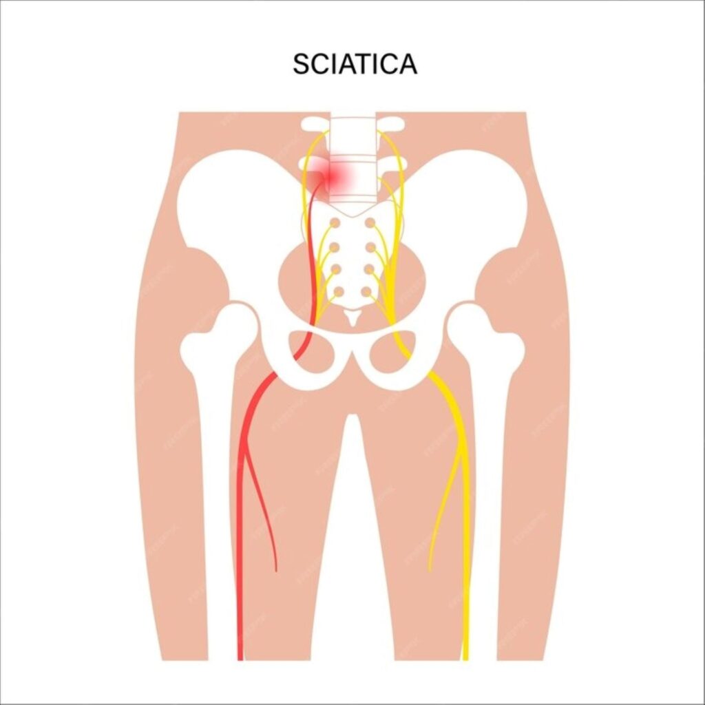 Sciatica