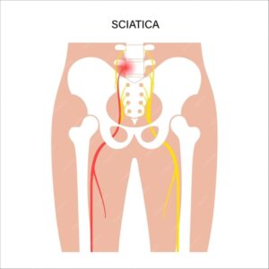 Sciatica