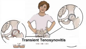 Transient-Tenosynovitis