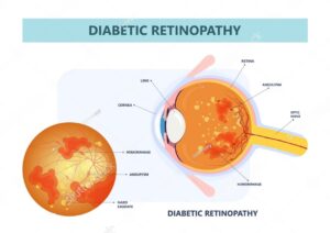 hypertensive-retinopathy