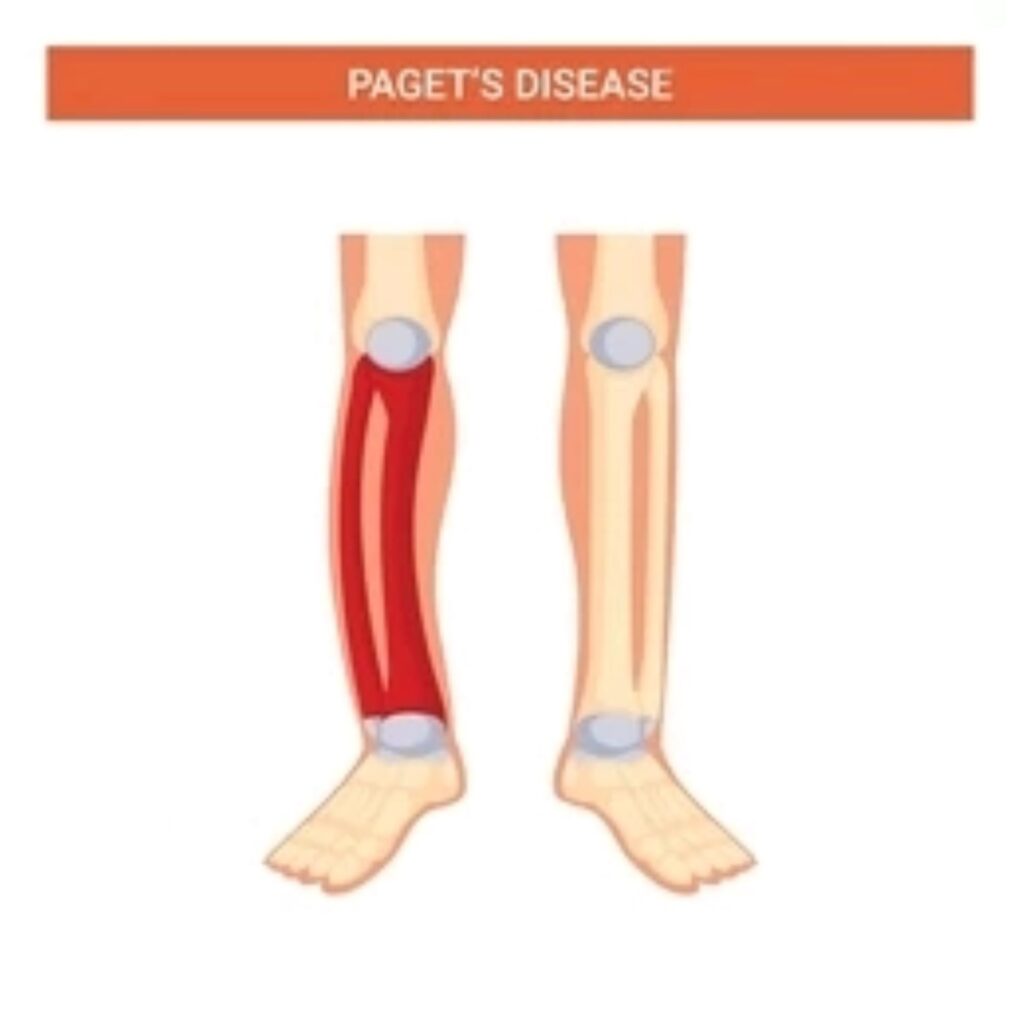 Paget's disease of bone