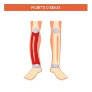 Paget's disease of bone