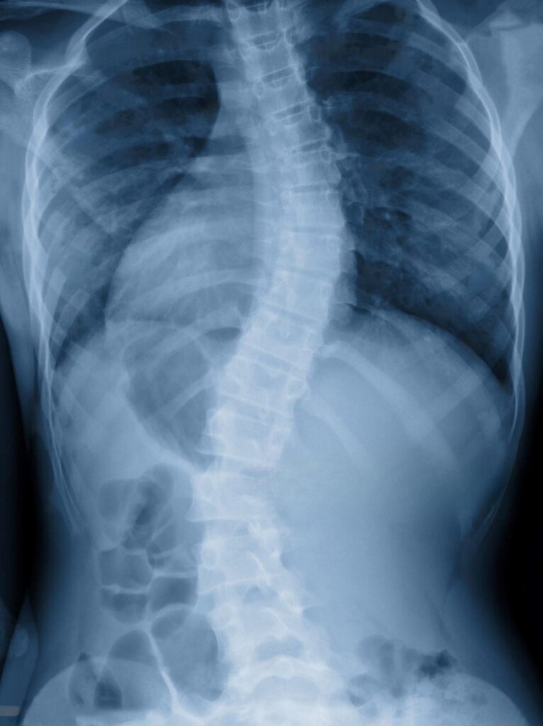 scoliosis