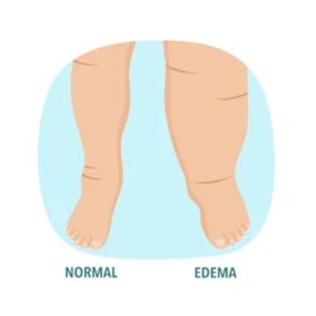 Edema