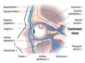 cavernous sinus thrombosis