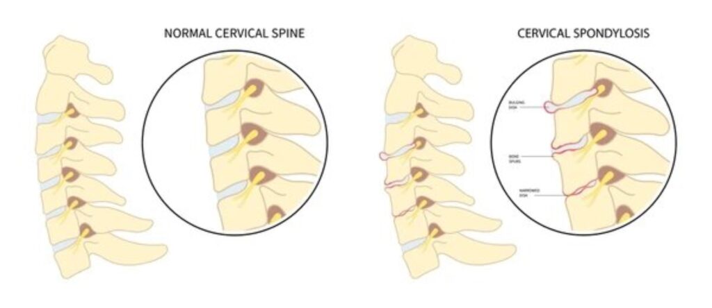 cervical spondylosis