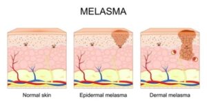 melasma