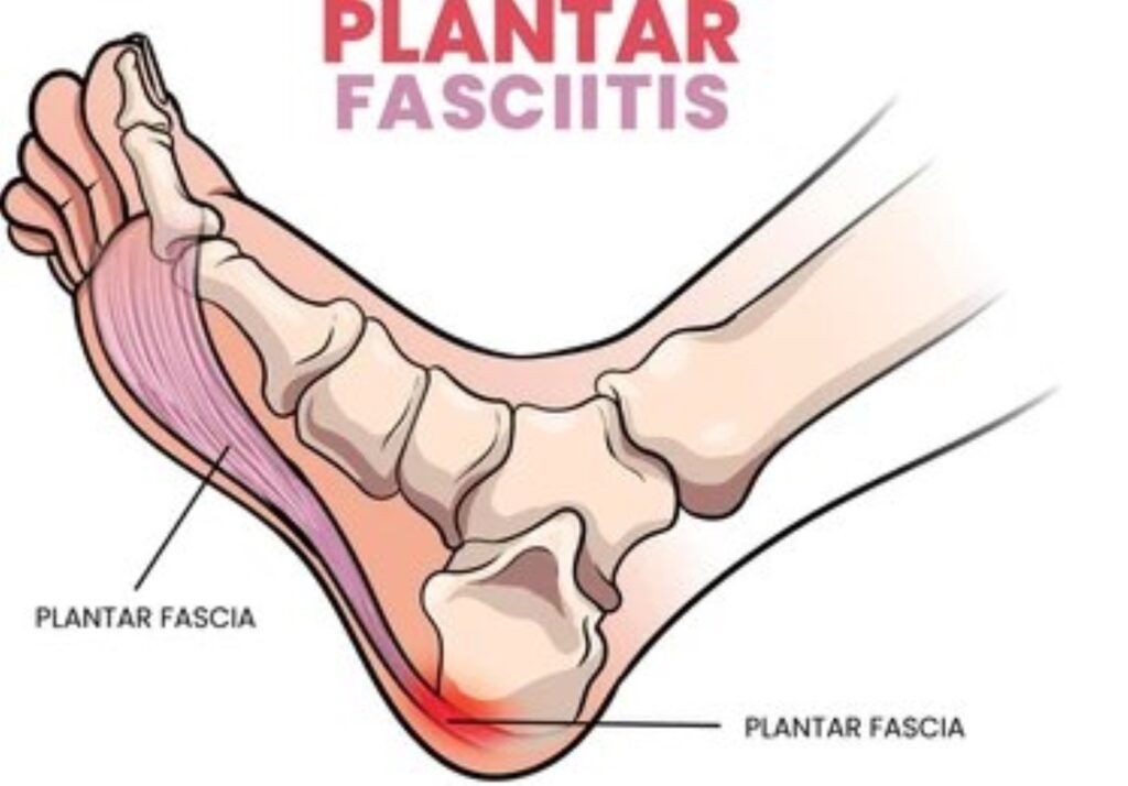 plantar fascitis