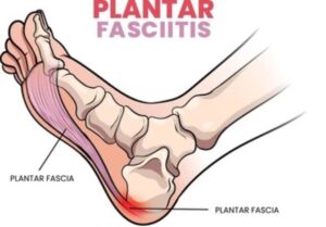 plantar fascitis