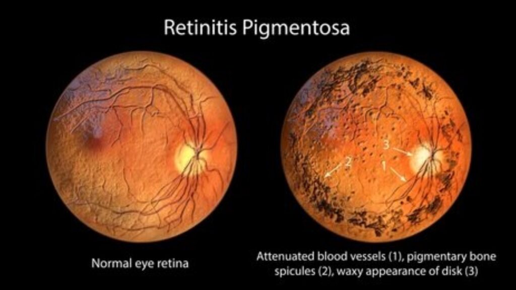 retinitis pigmentosa