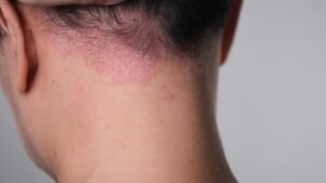 seborrheic dermatitis