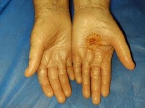 systemic sclerosis