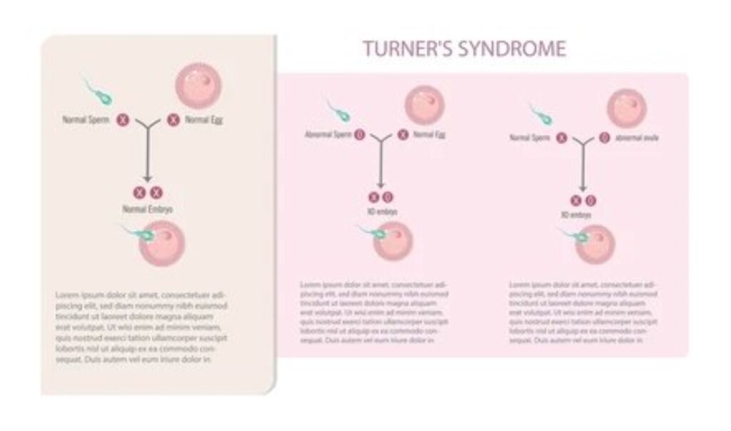 Turner Syndrome