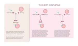 Turner Syndrome